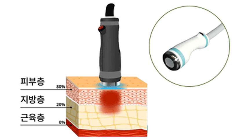3mm 핸드피스 원리