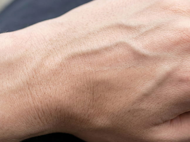 손등 필러 × 스컬트라