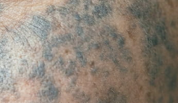 오타모반·난치성